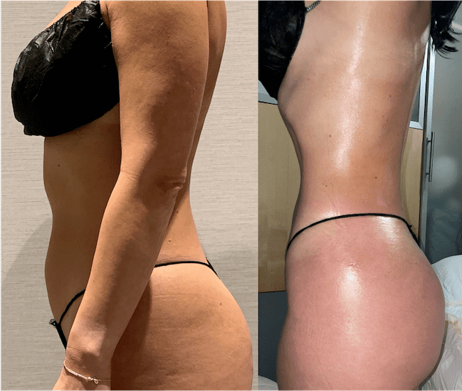 Before and after photo of a patient’s waist showing sculpted results from 360 degree Vaser liposuction in Turkey